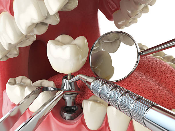 Best Emergency Tooth Extraction in Madera Acres, CA